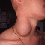 СПИД: симптомы заболевания.