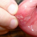 Первые симптомы и признаки СПИДа.